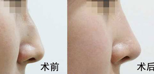 駝峰鼻矯正的方法有哪些？駝峰鼻矯正的方式及適合人群？