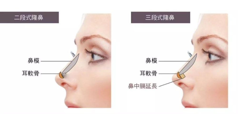 自體軟骨隆鼻的手術(shù)優(yōu)缺點(diǎn)有哪些？肋軟骨填充鼻基底多久能自然？