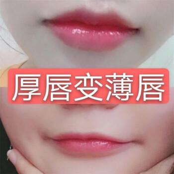 厚唇改薄整形手術(shù)價(jià)格？厚唇改薄多久完全恢復(fù)？