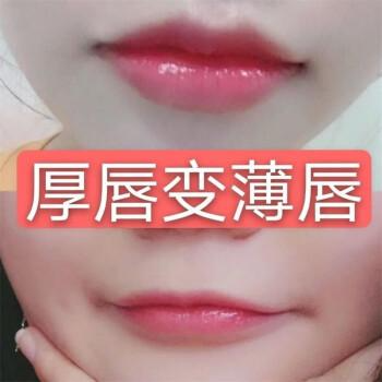 厚唇改薄整形手術(shù)價(jià)格？厚唇改薄多久完全恢復(fù)？