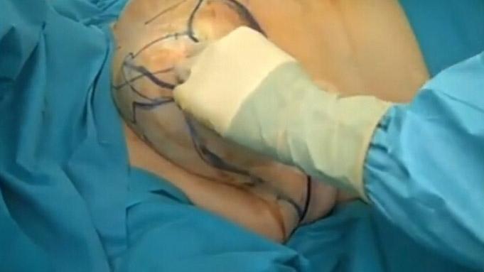 乳房縮小手術(shù)要多少錢？乳房縮小術(shù)是大手術(shù)嗎？