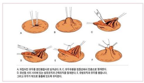 乳頭內(nèi)陷矯正手術(shù)多少錢？乳頭內(nèi)陷矯正手術(shù)多久可以恢復(fù)？