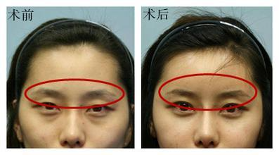 自體脂肪填充眉弓安全嗎？自體脂肪填充是永久的嗎？