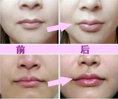 玻尿酸豐唇珠效果怎么樣？玻尿酸豐唇珠多少錢(qián)？