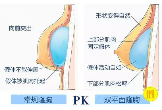 假體隆胸修復怎么做？做隆胸修復能維持多久？