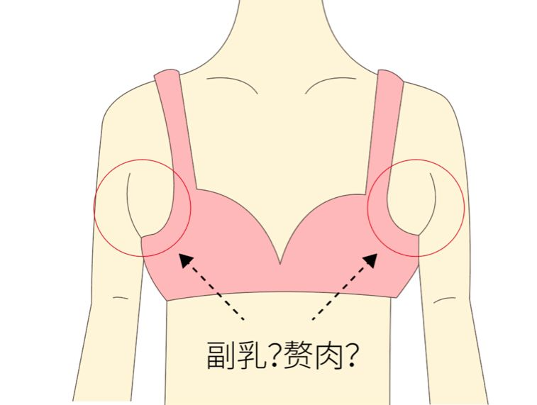 手術(shù)去副乳效果怎么樣？手術(shù)去副乳要注意什么？