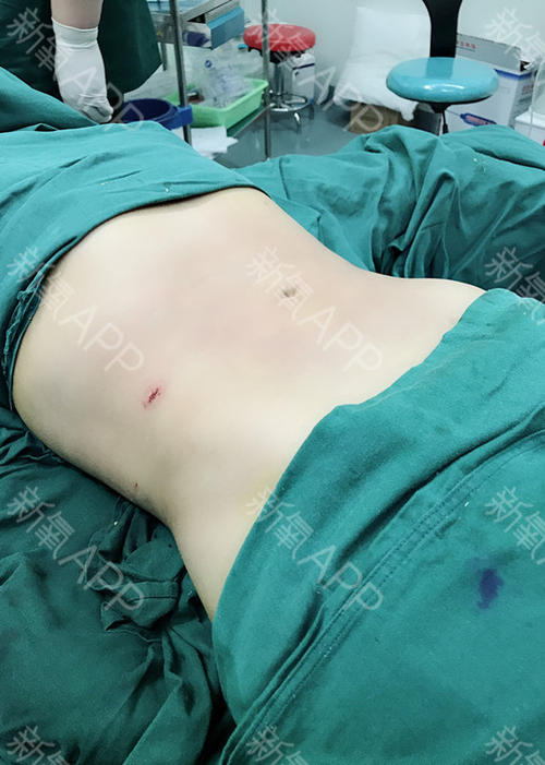 腰腹抽脂效果怎么樣？腰腹抽脂沒(méi)有瘦的原因？