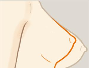 乳房下垂矯正手術(shù)風(fēng)險(xiǎn)有多大？ 乳房下垂矯正術(shù)多久能恢復(fù)？