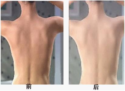 背部吸脂多久恢復(fù)？吸脂瘦背部注意事項(xiàng)