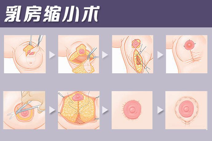女性乳房縮小多少錢 ？女性乳房縮小住院幾天？