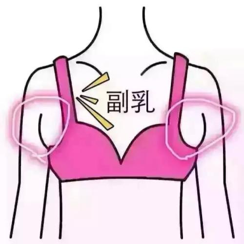 吸脂做副乳要多少錢？吸脂去副乳會反彈嗎？