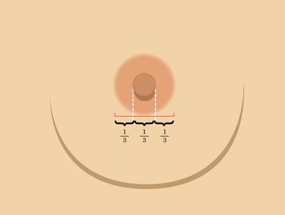 乳暈縮小如何矯正 乳暈縮小術(shù)的注意事項有哪些？