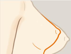 乳房下垂矯正手術(shù)風(fēng)險(xiǎn)有多大？ 乳房下垂矯正術(shù)多久能恢復(fù)？