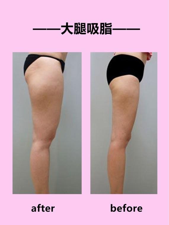 吸脂瘦大腿腫脹期是多久？大腿吸脂有什么后遺癥嗎？