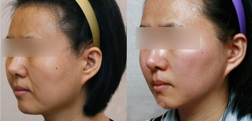 熱瑪吉做一次可以保持多久？熱瑪吉的原理和功效