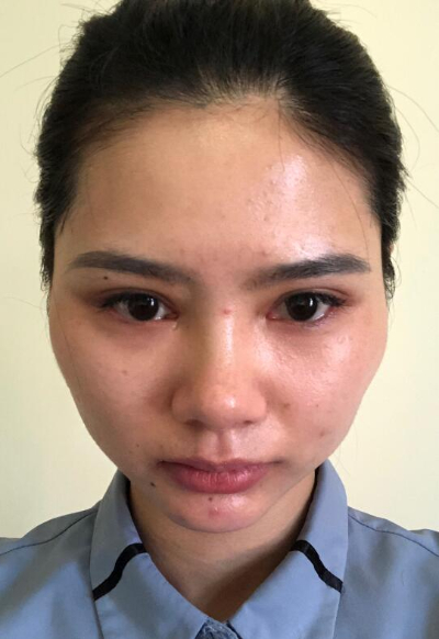 長春亞韓醫(yī)學美容醫(yī)院魏家賓面部吸脂案例效果分享