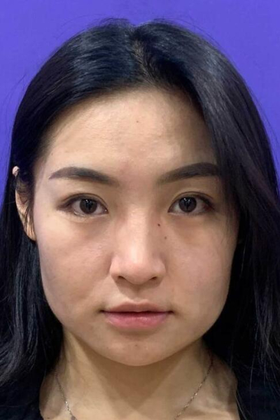上海美萊醫(yī)療美容門診部做熱瑪吉手術前臉部的狀態(tài)