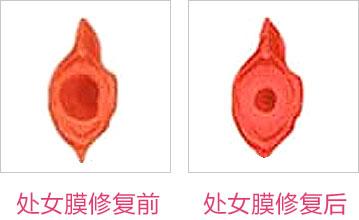成都東方整形處女膜修復(fù)怎么樣？處女膜修復(fù)術(shù)后如何護理？