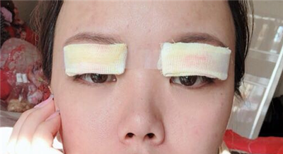 珠海韓妃醫(yī)療美容門(mén)診部李友良雙眼皮案例效果分享
