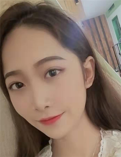 蘇州美貝爾美容醫(yī)院做面部吸脂手術(shù)后日?；謴?fù)效果