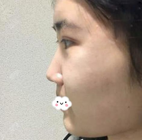 假體隆鼻假嗎？假體隆鼻三個(gè)月效果分享