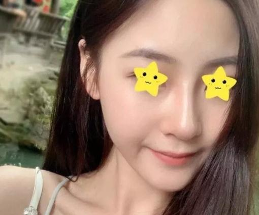 做綜合鼻，上海首爾麗格安建榮鼻綜合真人案例照片