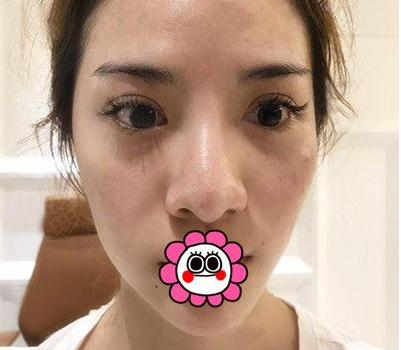 有“鼻王”之稱的楊群申做鼻子到底怎么樣？隆鼻前后圖片