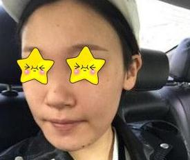 隆鼻真實案例，長沙亞韓鄭京湘隆鼻前后對比圖片