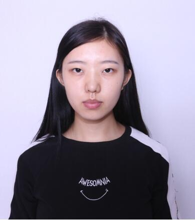 做雙眼皮案例，第四軍醫(yī)大學唐都醫(yī)院李望舟雙眼皮案例圖片