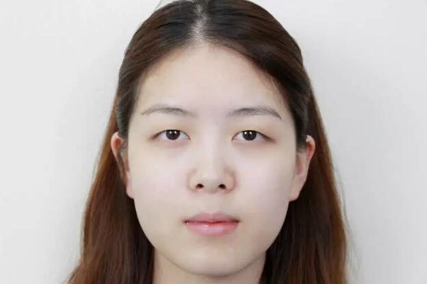 做雙眼皮案例，鄭州壹加壹王洛生全切雙眼皮案例圖片