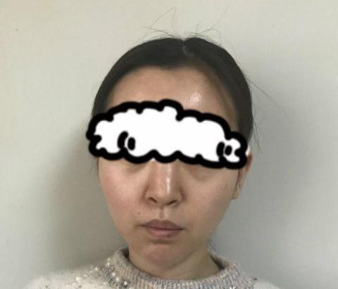 北京聯(lián)合麗格卓彥醫(yī)療趙瓊隆鼻失敗修復手術(shù)案例分享