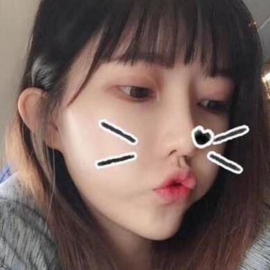 做雙眼皮案例，第四軍醫(yī)大學唐都醫(yī)院李望舟雙眼皮案例圖片