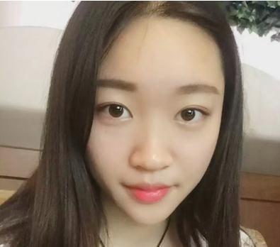 宜昌奧萊楊群申超體隆鼻案例分享，有圖
