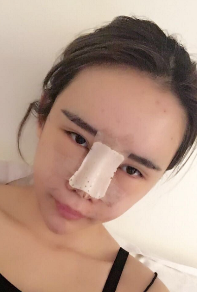 上海伊美爾港華醫(yī)療美容醫(yī)院做自體肋軟骨隆鼻手術剛剛結(jié)束