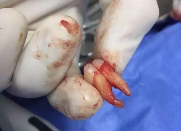 福州登特口腔拔智齒有哪些利弊？拔智齒有哪些情況？
