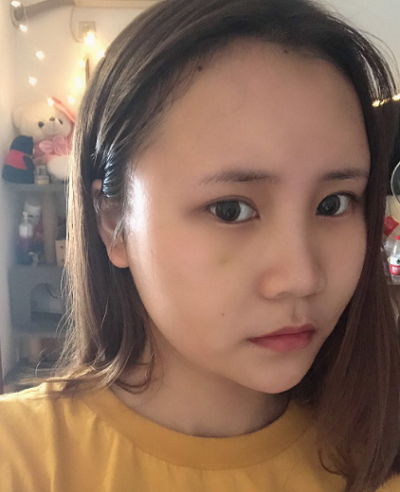 上海美萊醫(yī)療美容門診部做面部填充術(shù)后的日?；謴?fù)