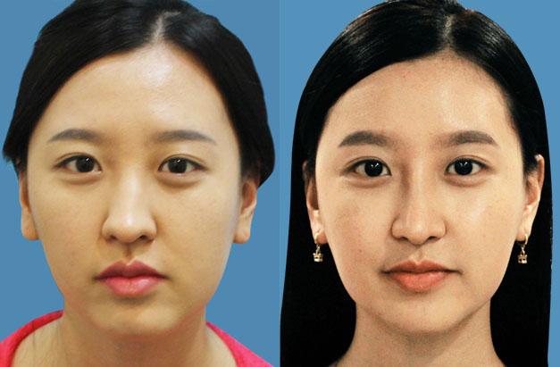 面部不對(duì)稱可以怎么矯正？臉一邊大一邊小怎么矯正？