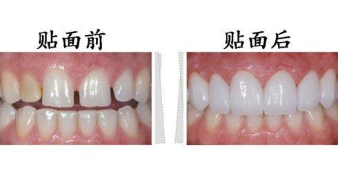 東莞拜博口腔瓷貼面有什么優(yōu)勢？瓷貼面有副作用嗎？