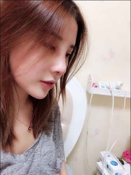 上海藝星醫(yī)療美容醫(yī)院做鼻綜合術(shù)后的日?；謴?fù)情況