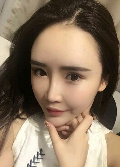 上海伊美爾港華醫(yī)療美容醫(yī)院做自體肋軟骨隆鼻手術拆線后