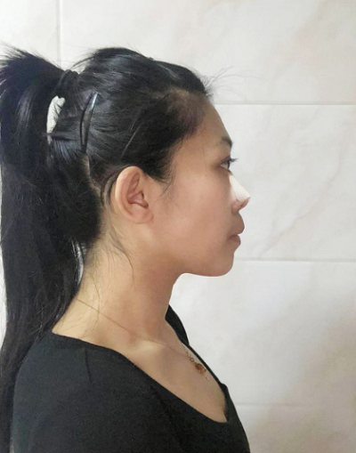 深圳恩吉娜醫(yī)療美容門(mén)診部做鼻綜合剛剛做完手術(shù)后