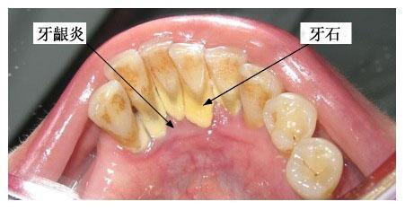  廣州柏德口腔牙齦炎怎樣治療吃什么消炎藥？