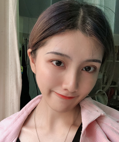 上海港華醫(yī)療美容醫(yī)院做隆鼻手術后的最終效果