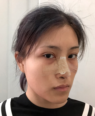 上海港華醫(yī)療美容醫(yī)院做隆鼻剛剛結束手術