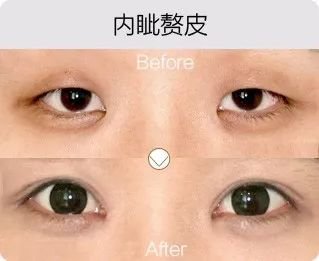 哈爾濱成美整形內(nèi)眥贅皮矯正怎么樣有哪幾種手術(shù)方法？