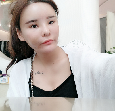 上海美萊醫(yī)療美容門診部做面部填充手術(shù)后的日?；謴?fù)